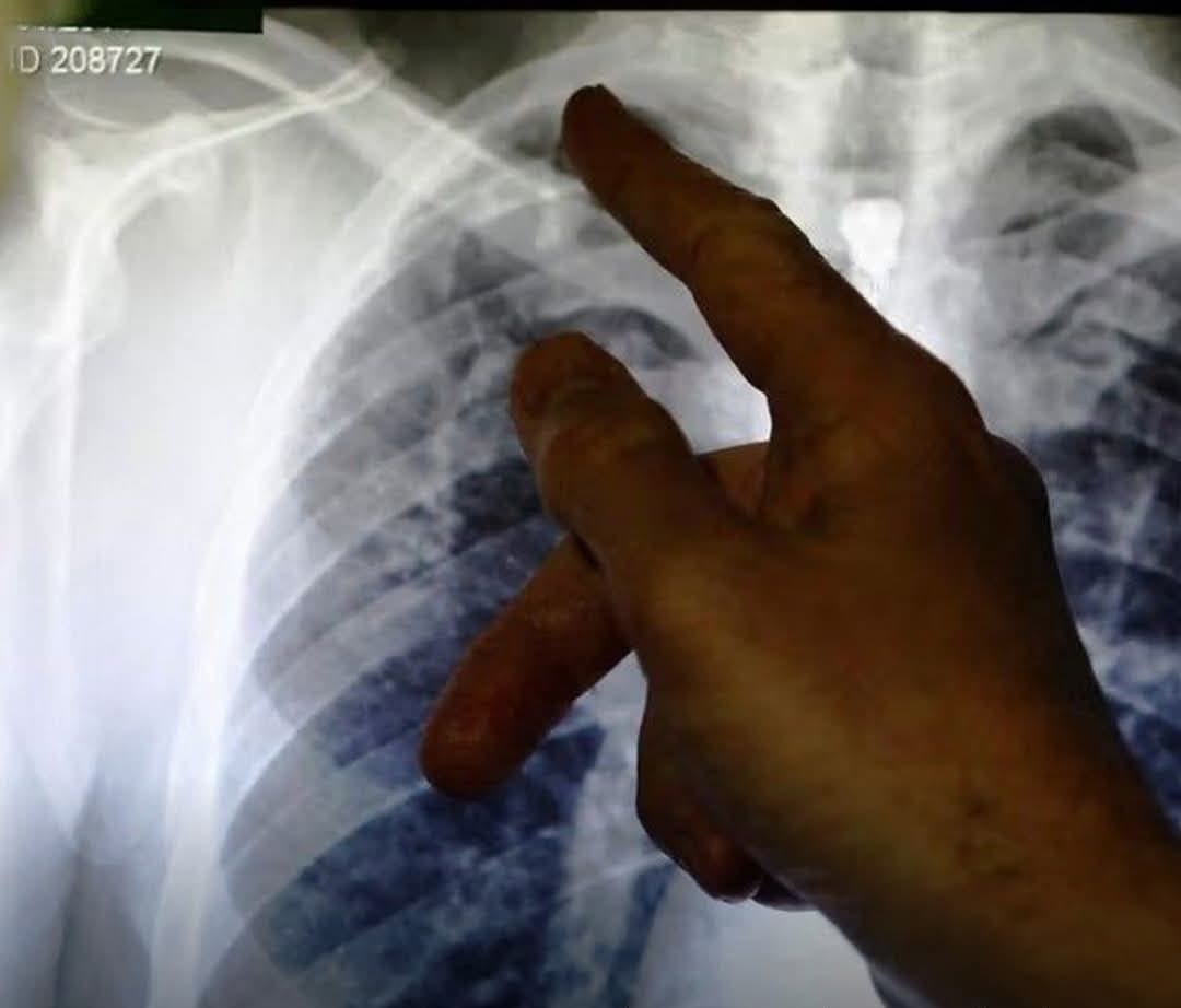 Unprecedented increase in tuberculosis among Afghan citizens in 2026